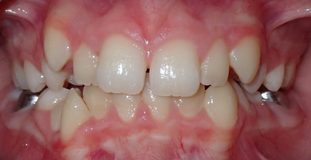 Vivid Smiles patient case 11 before and after treatment comparison before
